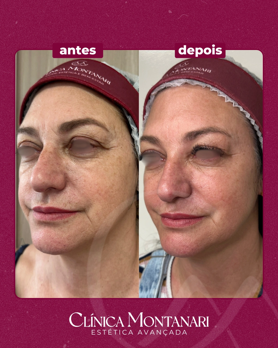 Resultado Clínica Montanari