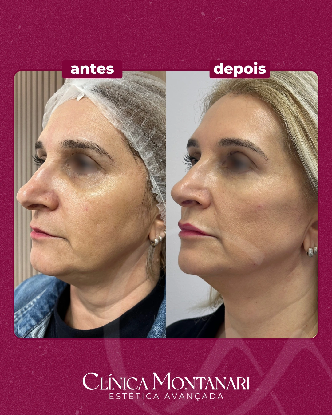 Resultado Clínica Montanari