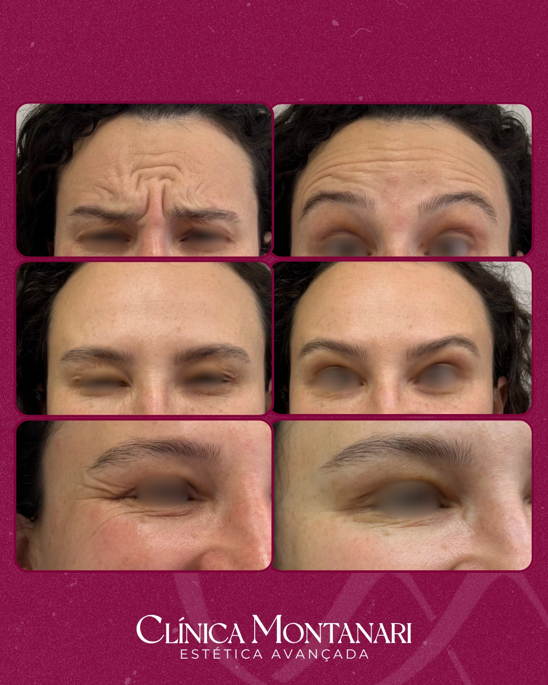 Resultado Clínica Montanari